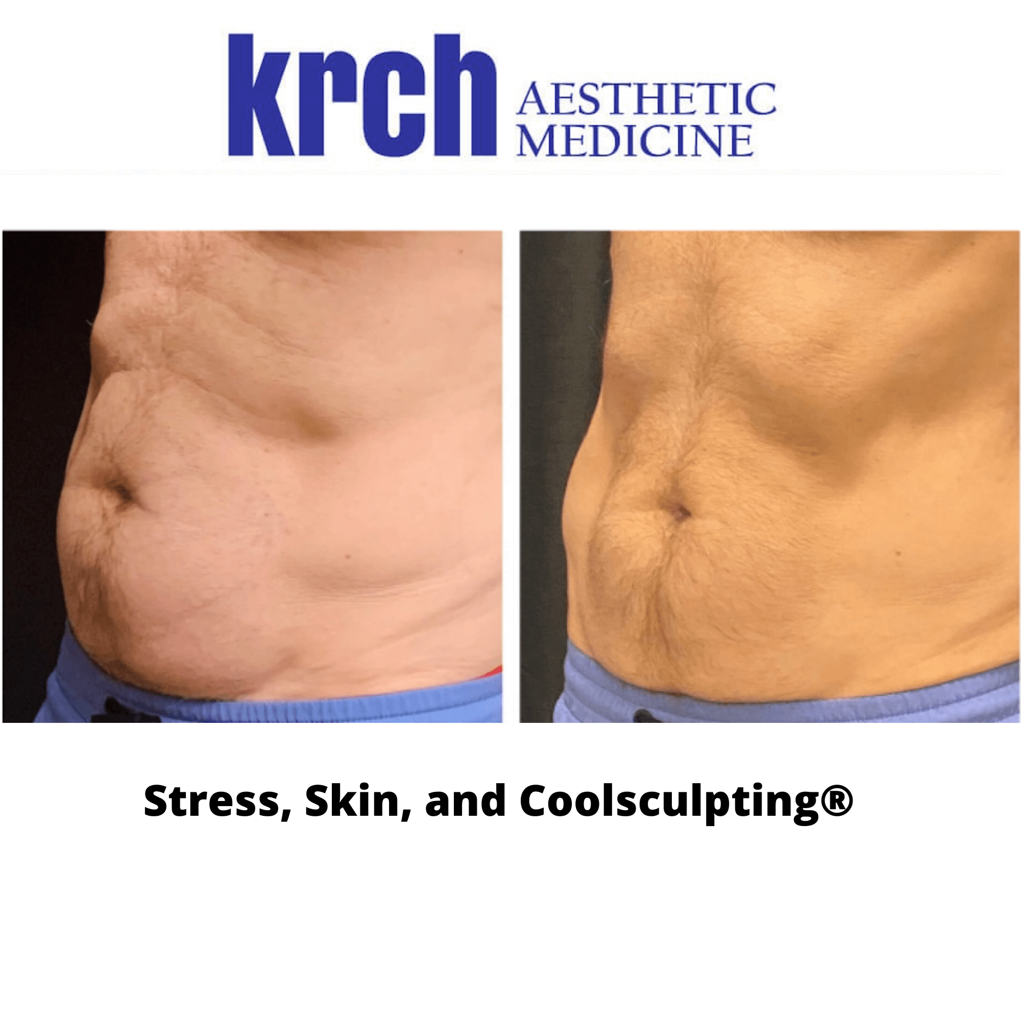 coolsculpting
