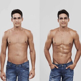 RF Body Contouring
